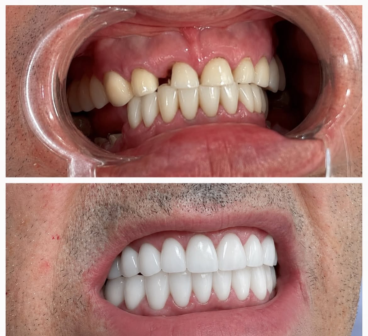 Full Zirconia Crown Reconstruction